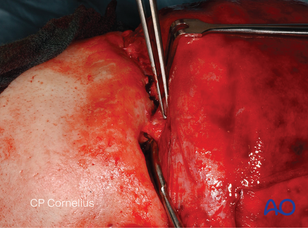 Clinical photograph showing subperiosteal exposure of the orbits and upper midface – coronal approach.