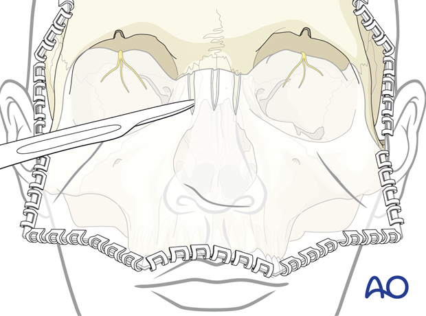 Retraction of the flap inferiorly is accomplished by subperiosteal dissection into the orbits – coronal approach.