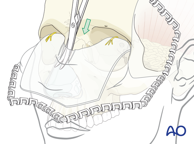 Dissection to the tip of the nose with Metzenbaum scissors – coronal approach.