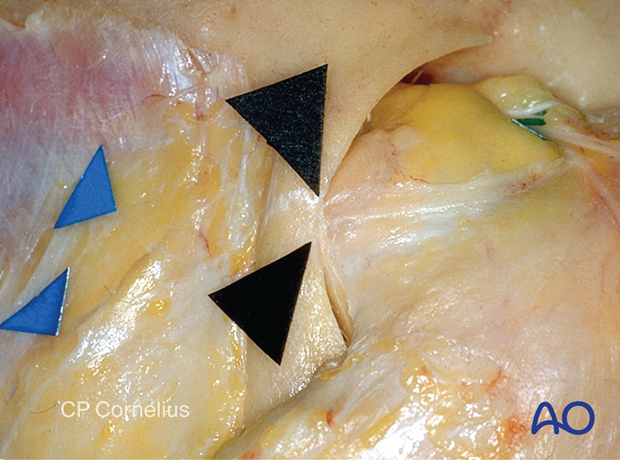 Photograph showing the detached the lateral canthal tendon and the lateral orbital rim – coronal approach.