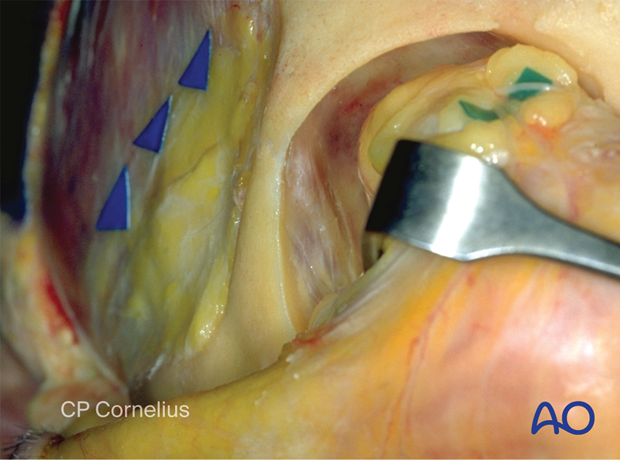 Photograph showing the dissection of the lateral orbital wall to the zygomatico-sphenoid suture – coronal approach.