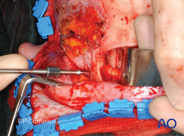 Clinical photograph showing the dissection of the lateral orbital wall – coronal approach.