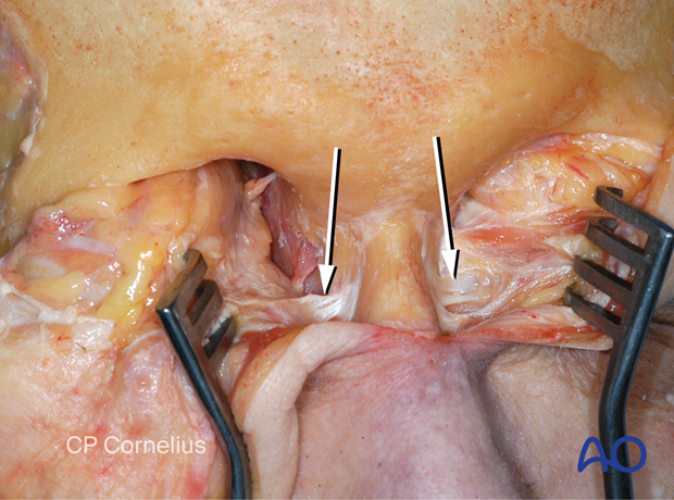 Clinical photograph showing the nasofrontal maxillary process and the anterior branch of the medial canthal tendon – coronal approach.