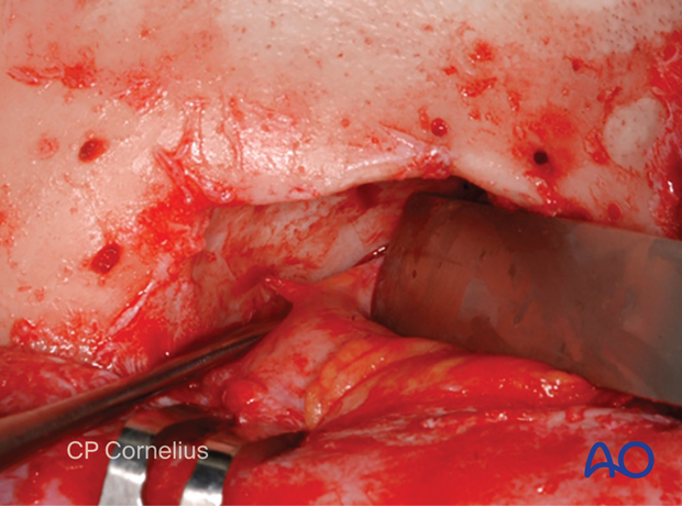 Clinical photograph showing the subperiosteal exposure of the orbits and upper midface – coronal approach.