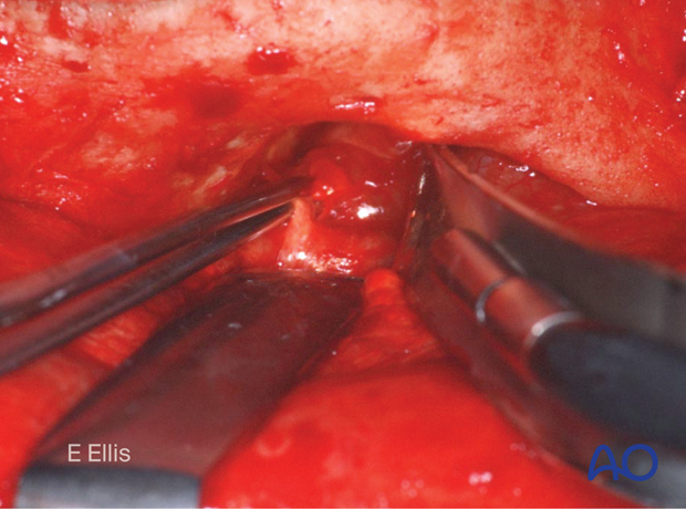 Clinical photograph showing the subperiosteal exposure of the orbits and upper midface – coronal approach.