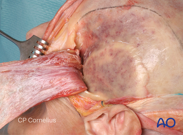 Clinical photograph showing the exposure of the temporal fossa – coronal approach.