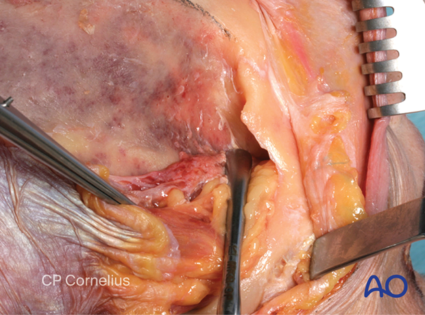 Clinical photograph showing the exposure of the temporal fossa – coronal approach.