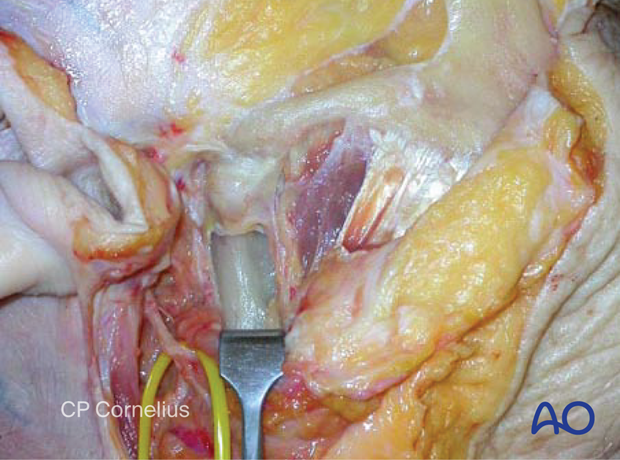 Exposure of the temporomandibular joint and mandibular condyle/ramus – coronal approach.