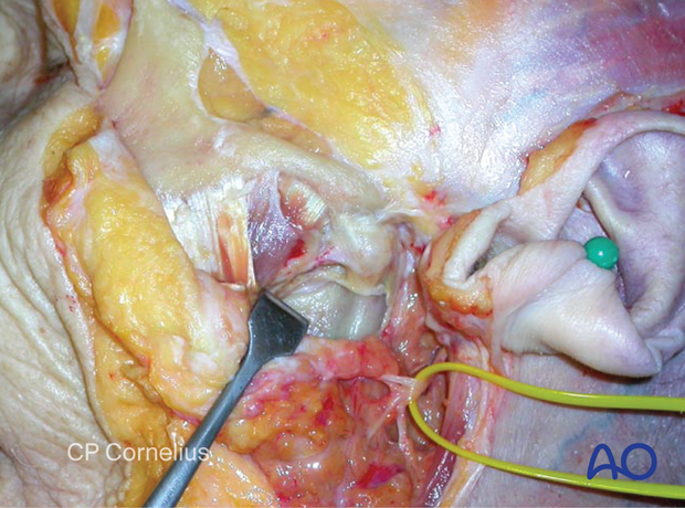 Exposure of the temporomandibular joint and mandibular condyle/ramus – coronal approach.