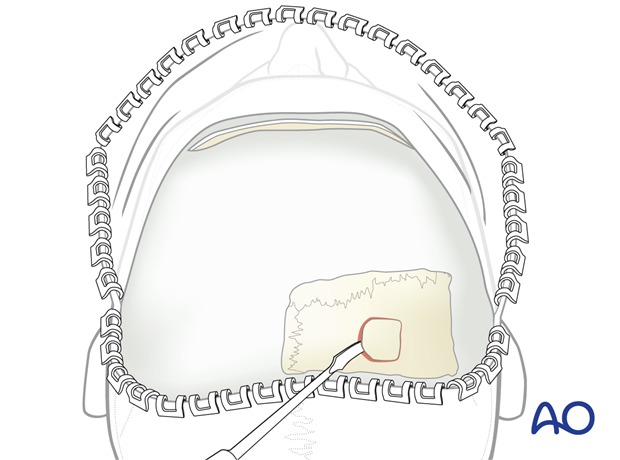 Harvesting cranial bone grafts – coronal approach.