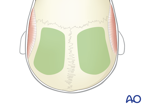 Parietal bone sources for harvesting cranial bone grafts – coronal approach.