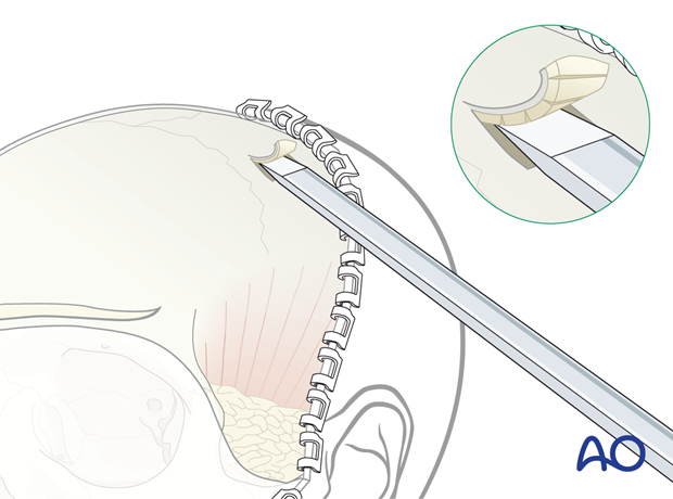 Harvesting shaved corticocancellous outer table graft with attached pericranium – coronal approach.