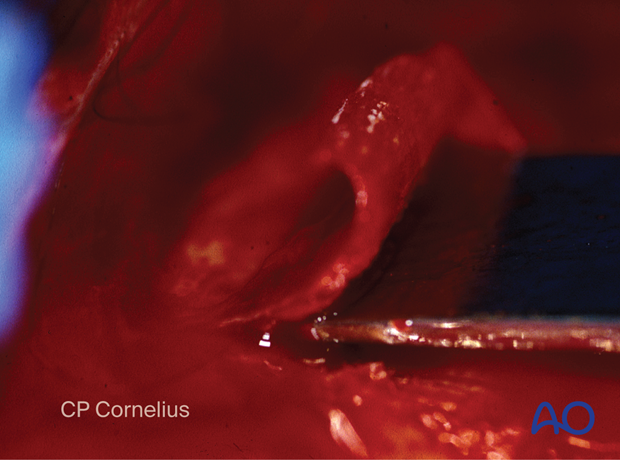 Clinical photograph showing harvesting cranial bone grafts – coronal approach.