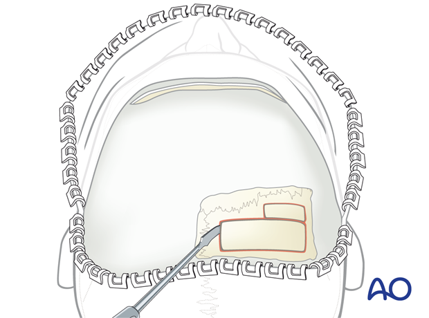 Harvesting cranial bone grafts with a curved osteotome – coronal approach.