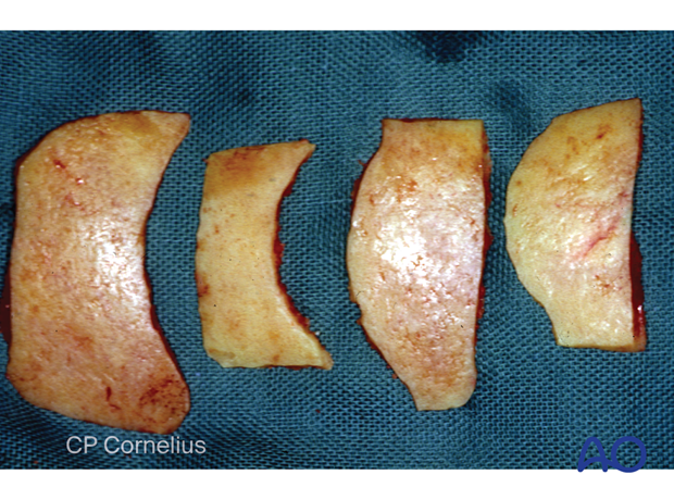 cranial bone grafts – coronal approach.