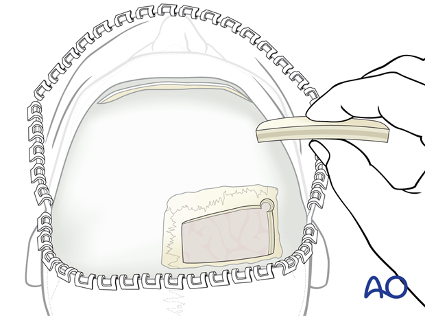 Full thickness parietal bone grafts – coronal approach.