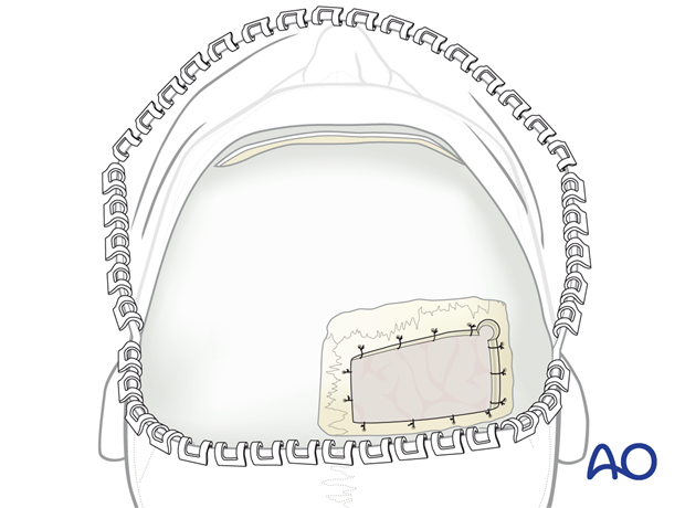 Dural suspension at the edges of the craniotomy – coronal approach.