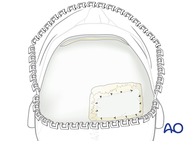 Defect filled with bone graft substitutes – coronal approach.