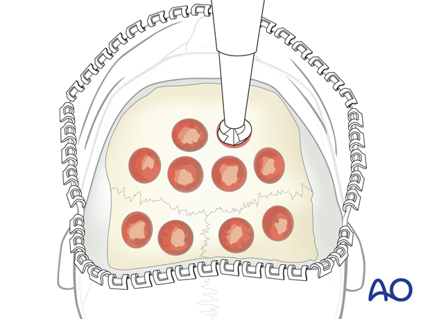 Harvesting cranial bone paste or bone dust– coronal approach.