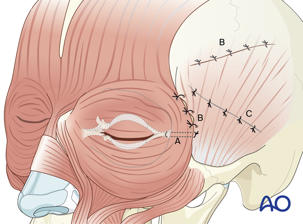 Order of resuspension of the facial envelope – coronal approach.