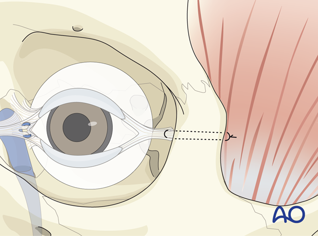 Lateral canthopexy – coronal approach.