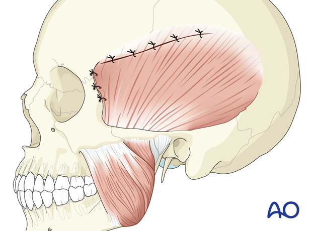 Resuspension of the temporalis muscle – coronal approach.