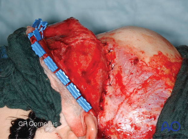 Resuspension of the superficial layer of the temporalis fascia – coronal approach.