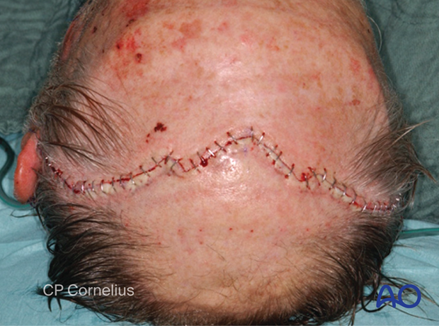 Skin closure – coronal approach.