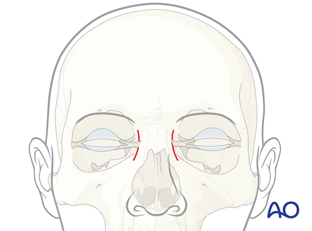 Ethmoidal approach.