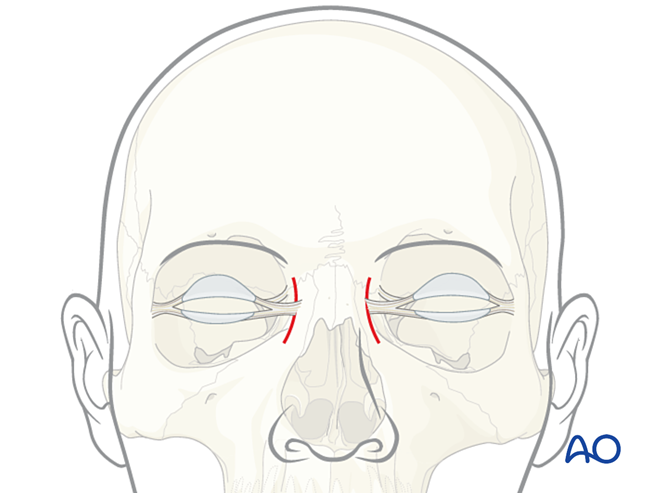 All approaches for the management of midface injuries