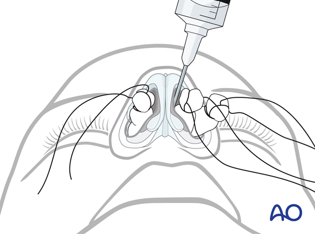 Preparing the nasal cavity with nasal packings and with a vasoconstrictor – endonasal approaches.