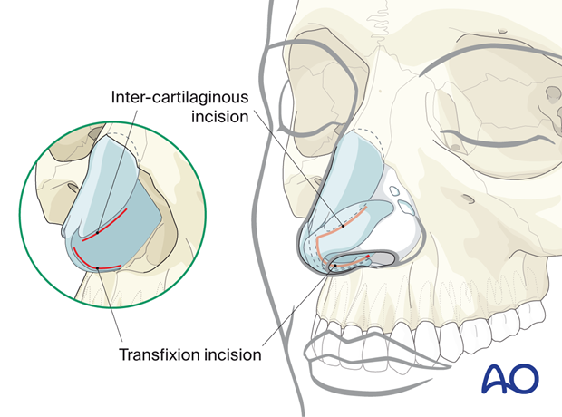 Intercartilaginous and the transfixion incisions – endonasal approaches.