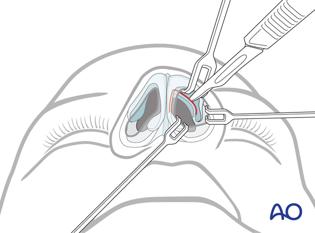 Intercartilaginous incision