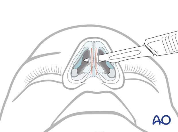 Making the transfixion incision at the caudal end of the septal cartilage dissection – endonasal approaches