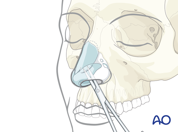 Using pointed scissors for subperichondrial dissection – endonasal approaches.