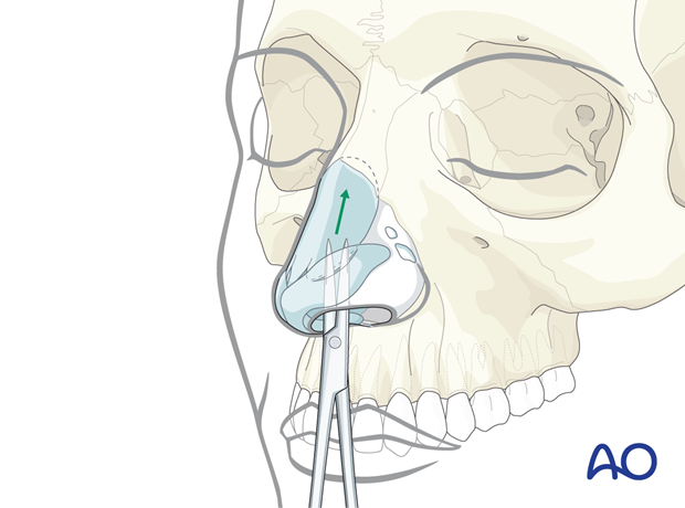 Accessing the nasal dorsum and the root of the nose through the intercartilaginous incision – endonasal approaches.