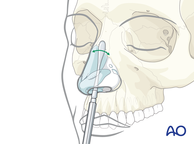 Using a periosteal elevator for subperiosteal dissection of the nasal bones – endonasal approaches.