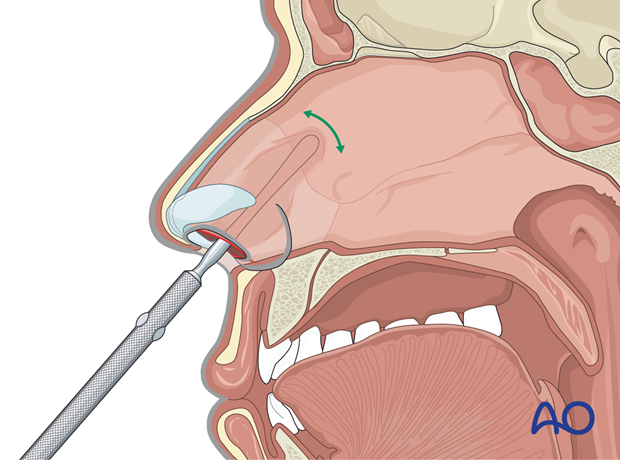 Using a freer elevator in a sweeping motion through the transfixion incision – endonasal approaches.