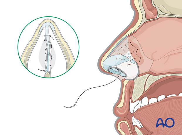 Closure using a quilting suture – endonasal approaches.