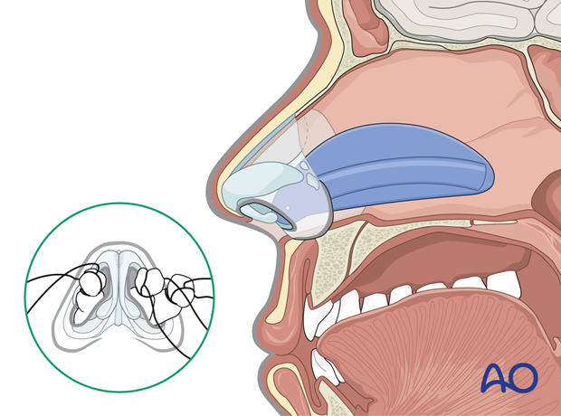 Intranasal silastic (Doyle) splint.