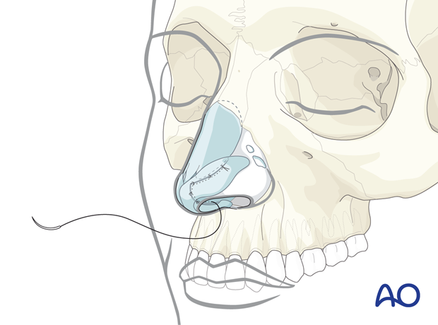 Using interrupted absorbable sutures to reapproximate the mucosal incisions – endonasal approaches.