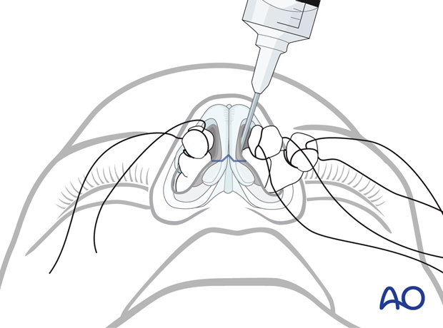 Lower nose and septum are injected with a local anesthetic with vasoconstrictors – external rhinoplasty approach (open).