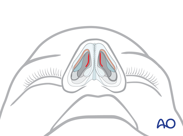 Incisions are made along the caudal borders of the lower lateral cartilages – external rhinoplasty approach (open).