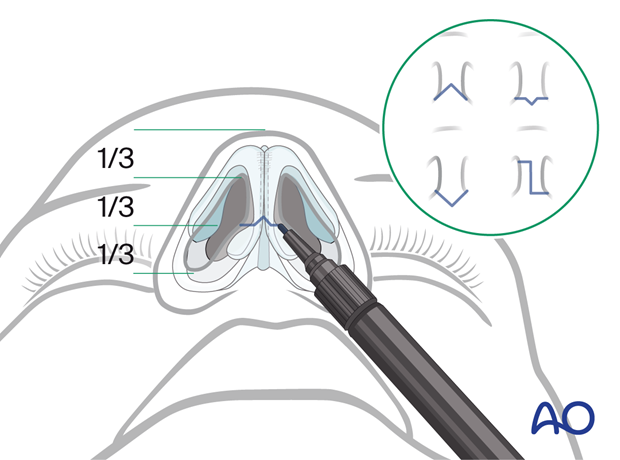 Most common incisions for external rhinoplasty approach (open).