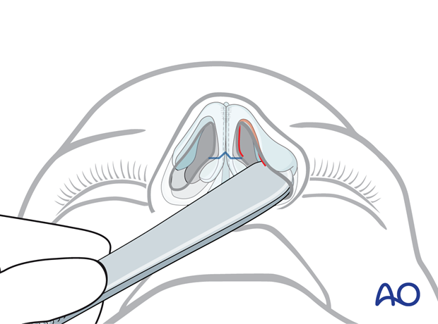 Using the back end of the knife handle to identify the caudal border of the cartilage – external rhinoplasty approach (open).