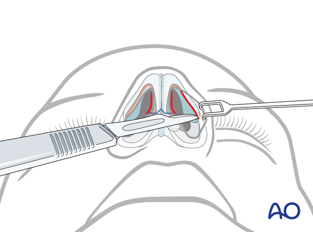 Incising the mucosa – external rhinoplasty approach (open).