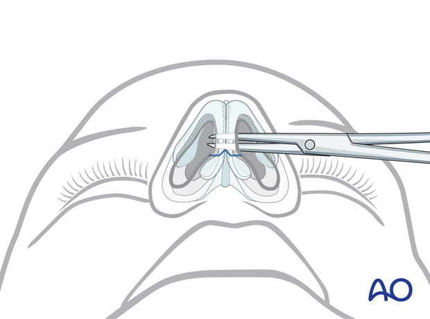 Opening the scissors to separate the columellar skin from the cartilages – external rhinoplasty approach (open).