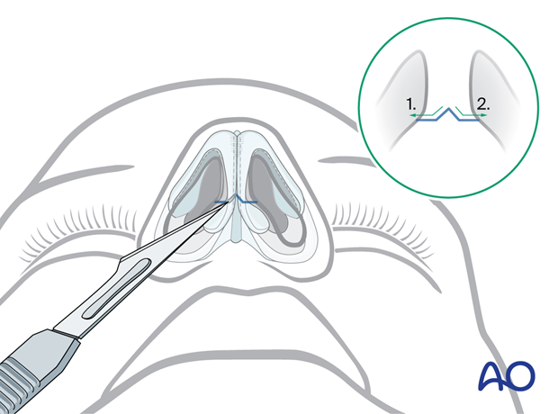 Columellar incision – external rhinoplasty approach (open).