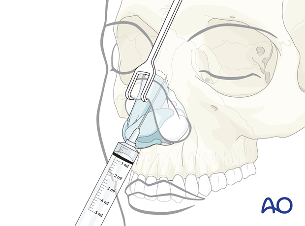 Lifting the columellar flap with a fine skin hook – external rhinoplasty approach (open).