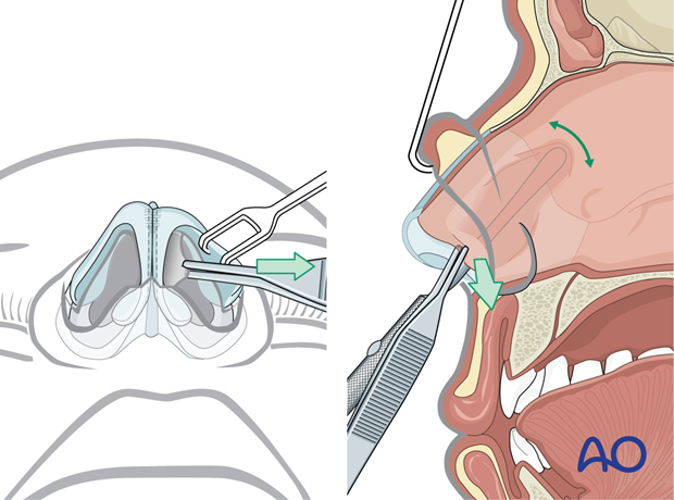 Exposure of the nasal septum – external rhinoplasty approach (open).